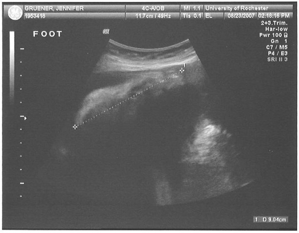 Ultrasound (foot)