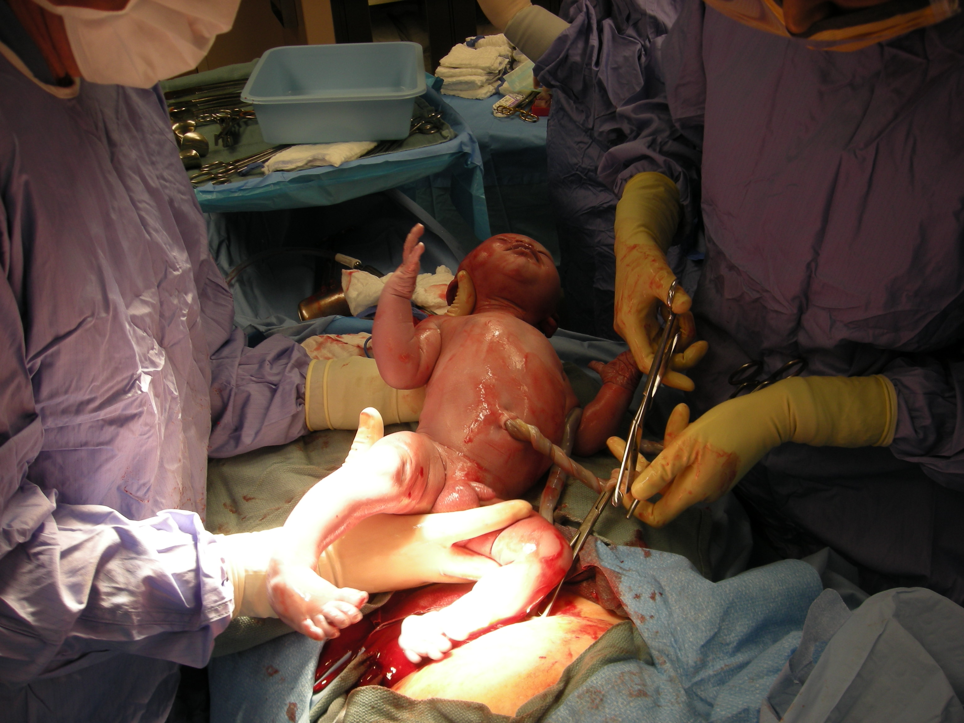 Cutting the umbilical cord